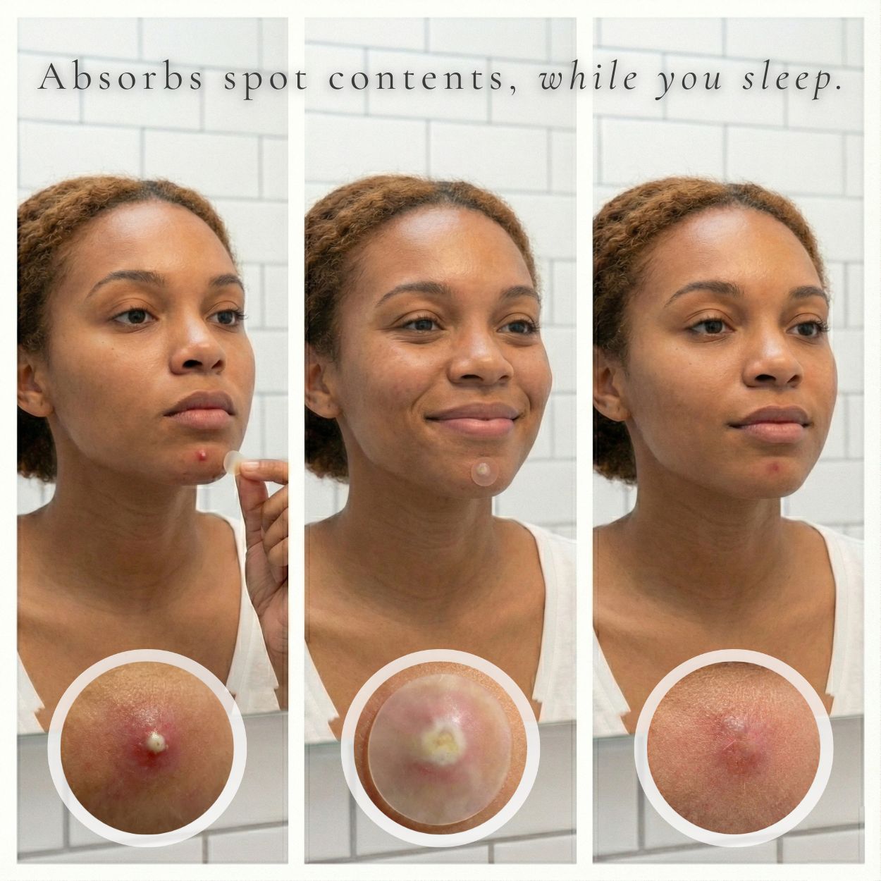 Three stages of a woman applying a pimple hydrocolloid patch to her face with close-ups showing spot absorption.