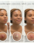 Three stages of a woman applying a pimple hydrocolloid patch to her face with close-ups showing spot absorption.